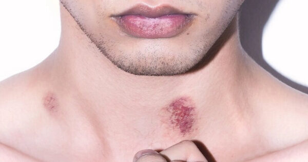 hickey la gi 3